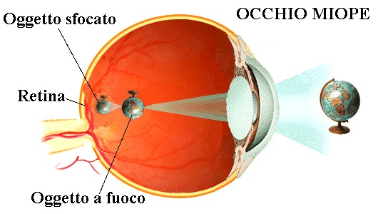 Miopia togliere occhiali da vicino deals